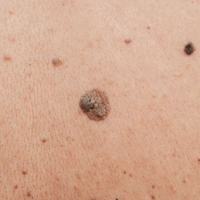 How Effective Skin Cancer Treatment Protects Your Health and Your Future